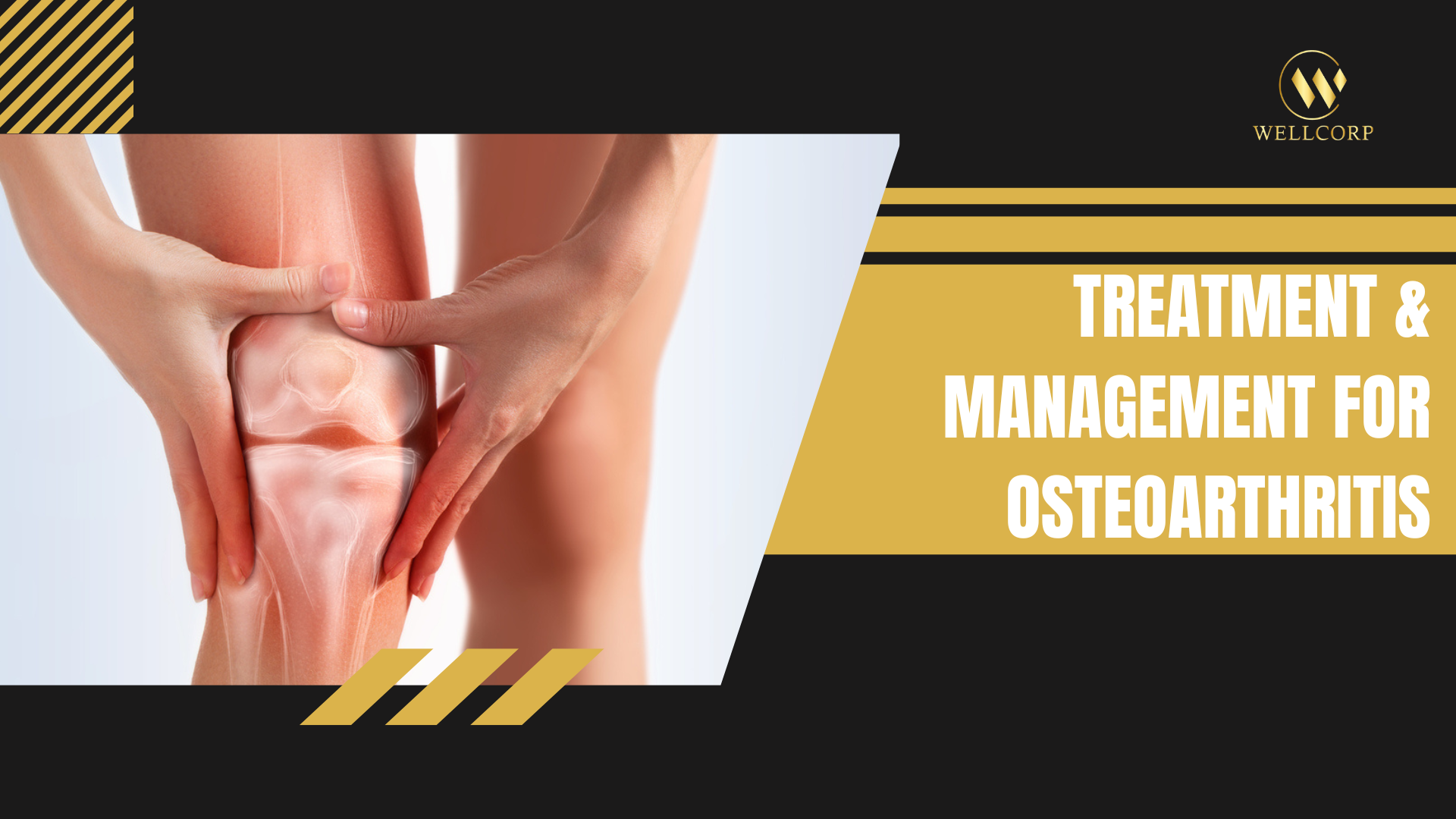Treatment & Management for Osteoarthritis