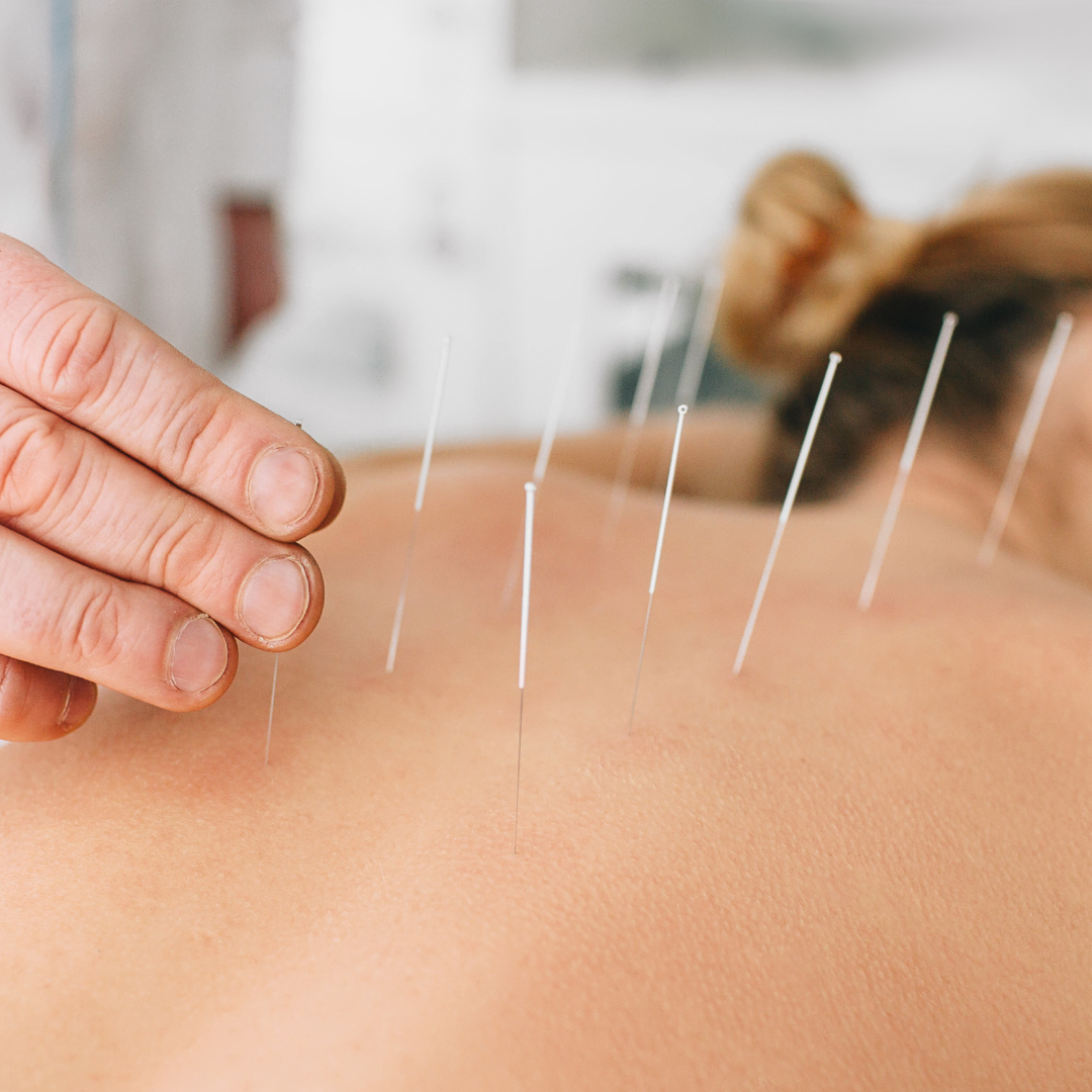 Dry Needling & Cupping